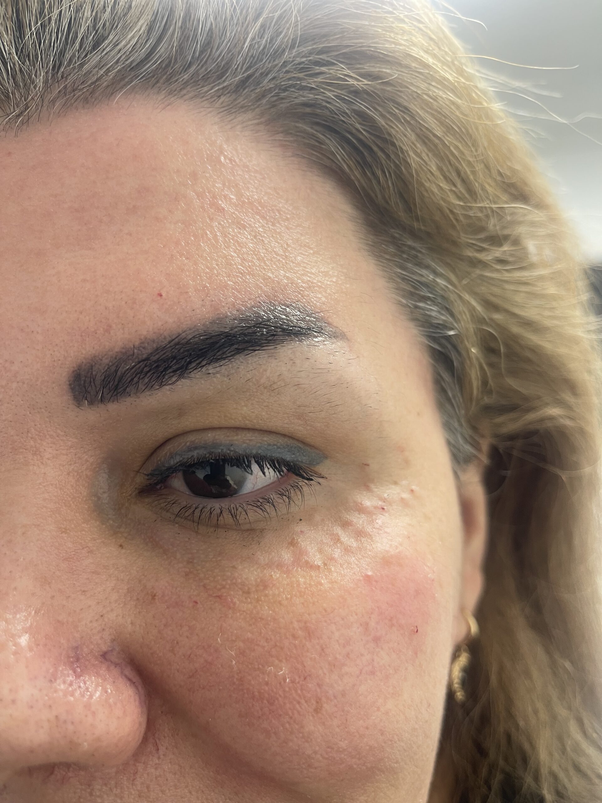 بوتاکس، اسکین بوسترها، مزو زیر چشم