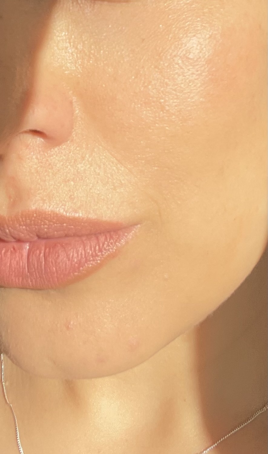 بوتاکس، اسکین بوسترها، مزو زیر چشم