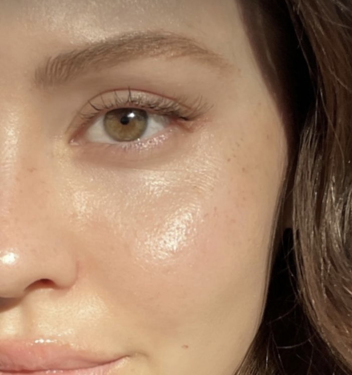 بوتاکس، اسکین بوسترها، مزو زیر چشم