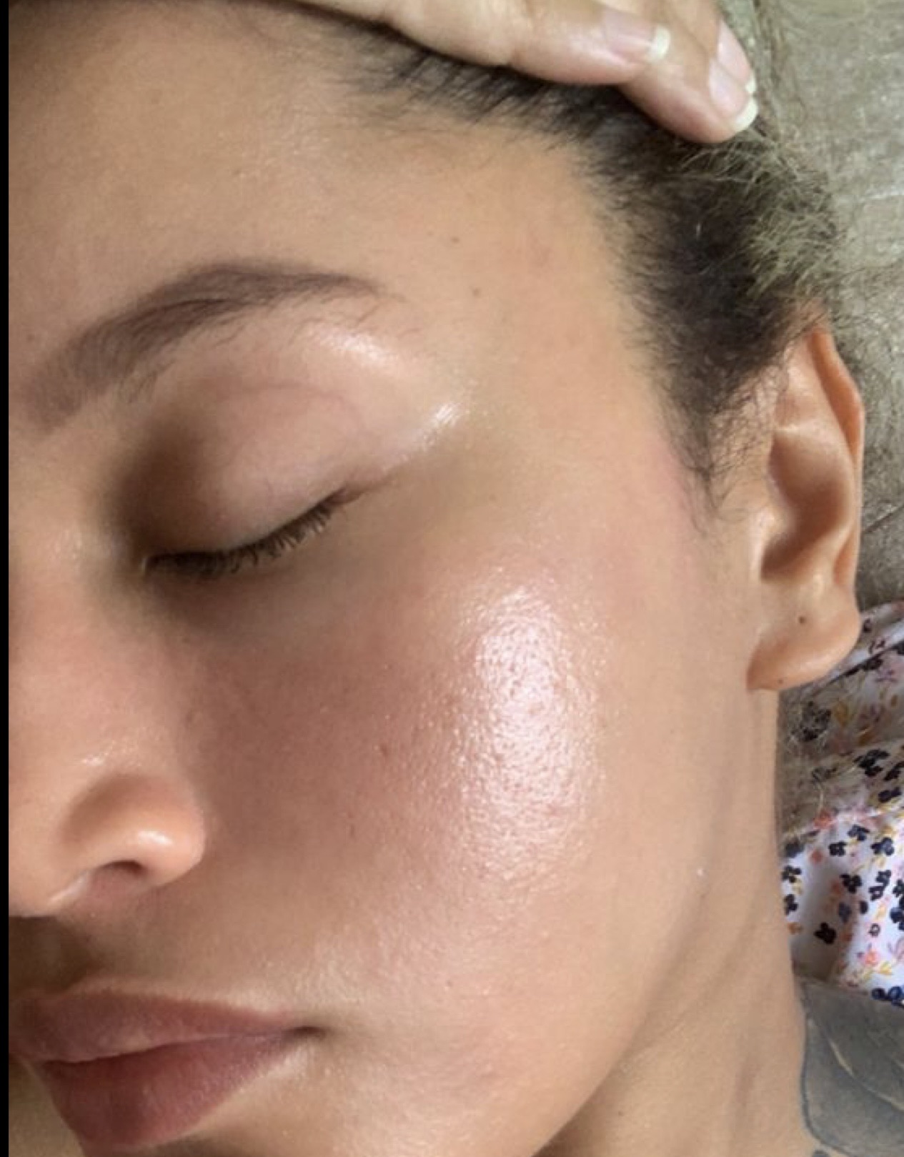 بوتاکس، اسکین بوسترها، مزو زیر چشم